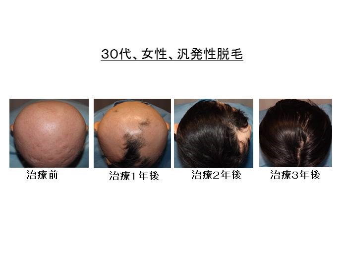 汎発性脱毛の患者様、ほぼ完治へ。 患者様からの声・メディア掲載・クリニックからのお知らせ 名古屋Kクリニック